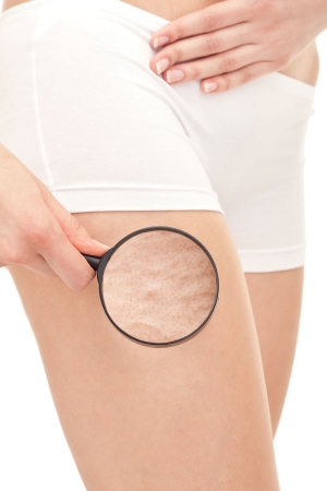 A New Concept in Cellulite Etiology and Treatment