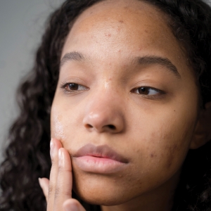 Collective Care: Acne &amp; Multicultural Skin