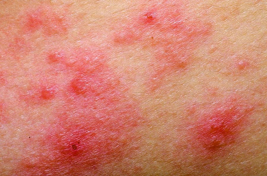 Recent Developments in Atopic Dermatitis Research Uncovers Impact on Quality of Life and Mental Health