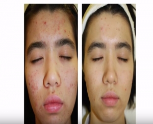Video: DMK&#039;s non-invasive anti-acne treatment you have to try!