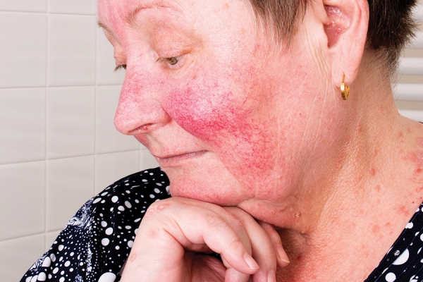 On Red Alert: Recognizing the Common Symptoms and Triggers of Rosacea