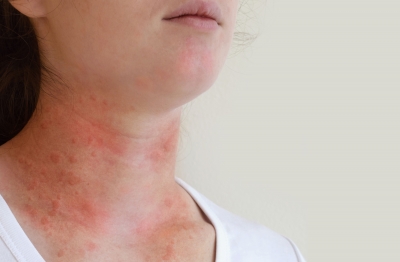 Urticaria Uncluttered: Treating & Preventing Hives
