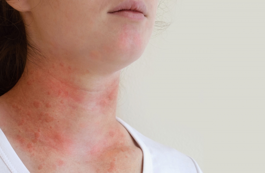 Urticaria Uncluttered: Treating &amp; Preventing Hives