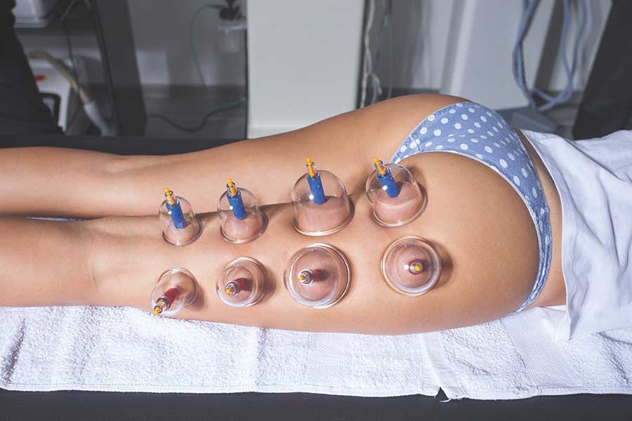 Cellulite Cupping: An Ancient Method Gaining Popularity Today