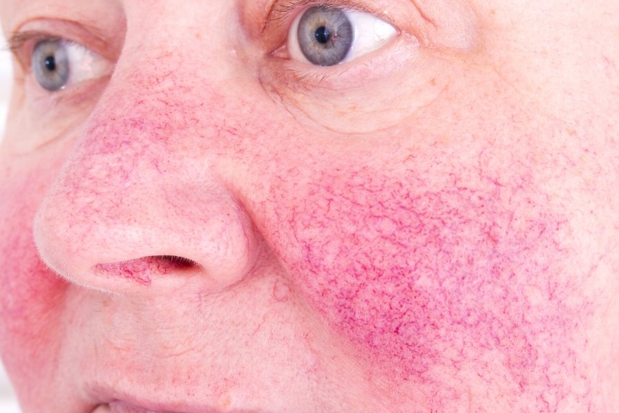 Can You Spot the Difference? Couperose Versus Rosacea