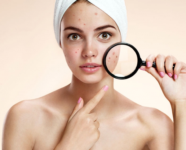 The Difference Between Dry Acne and Oily Acne