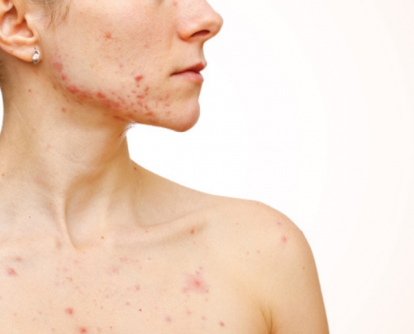 Acne on the Body