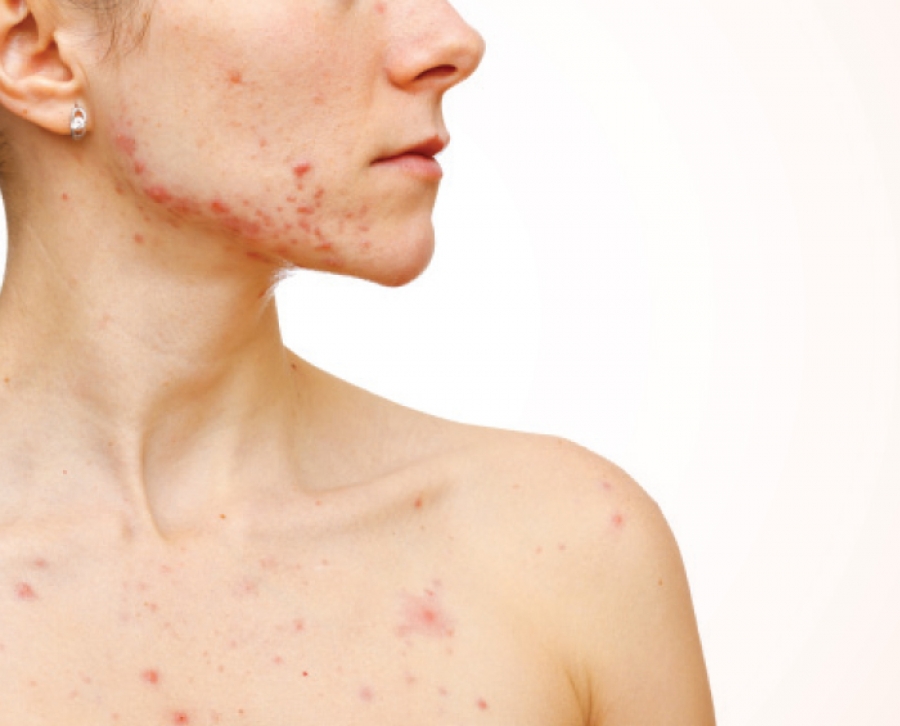 Body acne severe What can
