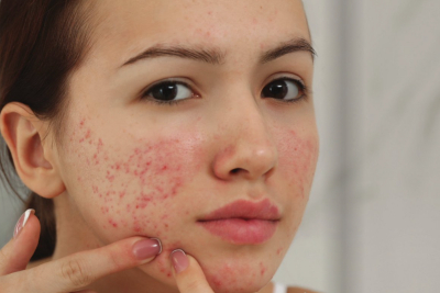 The Teenage Acne Survival Guide