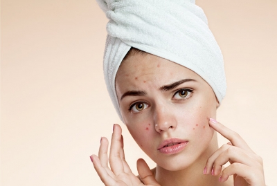 A STEP-BY-STEP:  Acne Treatment and Proper Extraction Protocol