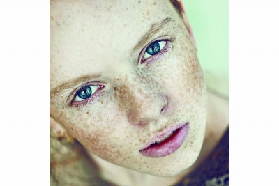 Hyperpigmentation: Looking at Age and Sun Spots through the Right Lens
