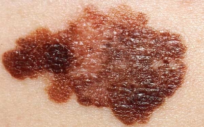 Rise of Skin Cancer