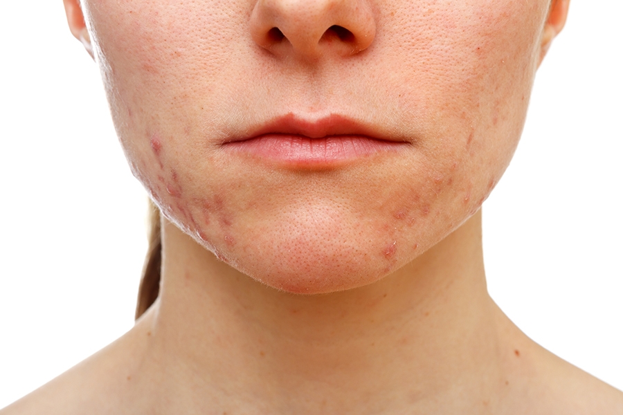 Antimicrobial Peptides: Addressing Microflora and the Microbiome to Treat Acne