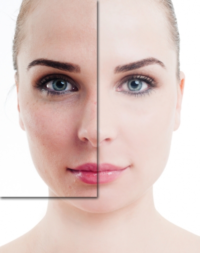 Results in a Flash: Using Intense Pulsed Light Treatment for Maximum Results