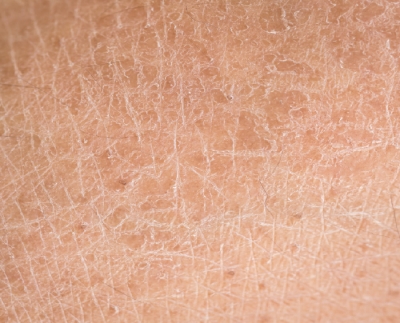 Dealing with Diabetic Skin Care Problems