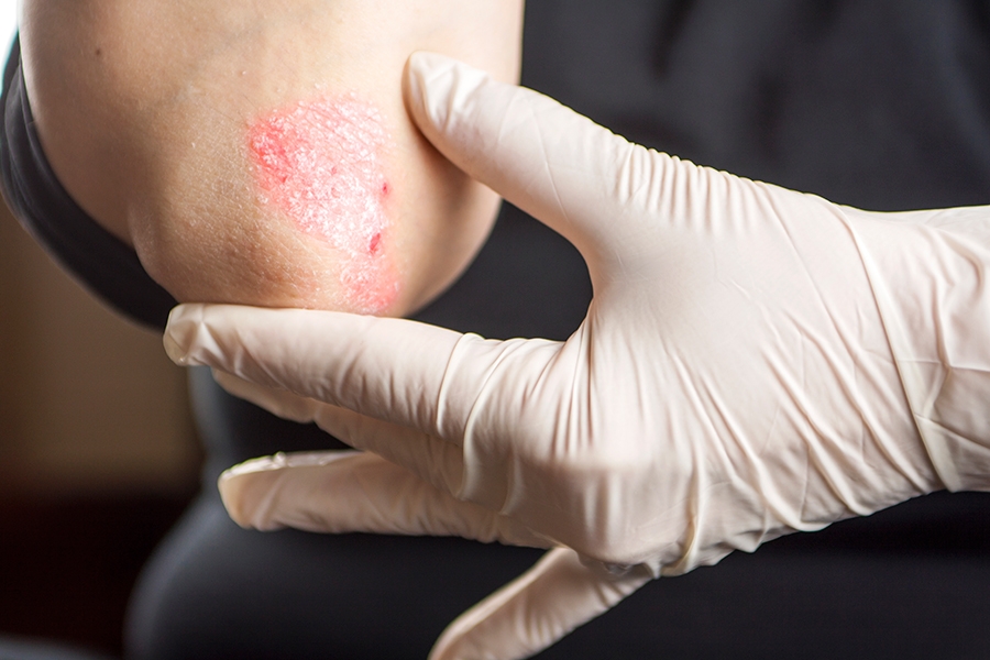 Fact or Fiction: Psoriasis is caused by  a build-up of dry skin.