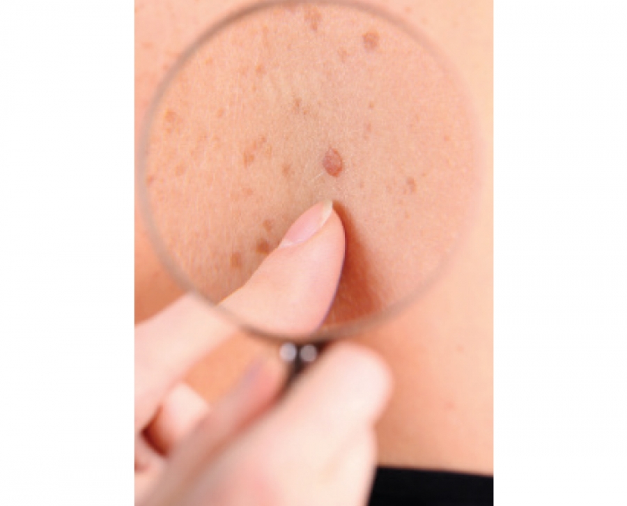 Tips for Detecting Melanoma Early
