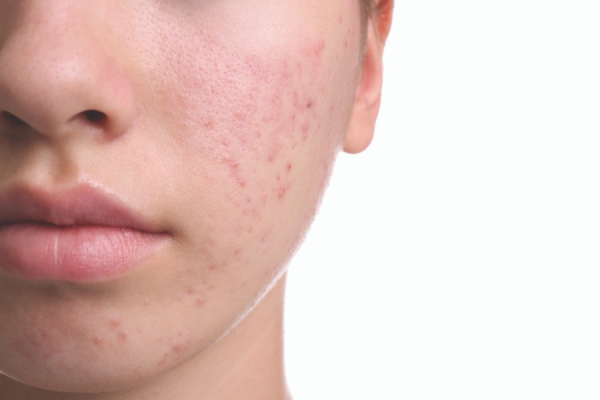 Picking Problems: Addressing Post-Inflammatory Hyperpigmentation in the Spa