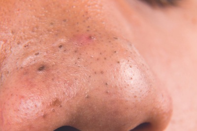 Pore Things: The Miseducation of Blackheads & Pore Appearance 