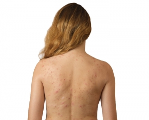 Surprising Causes of Body Acne