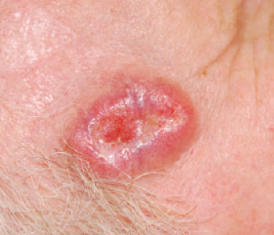 Skin Cancer 101: A review of the 3 most common skin cancers