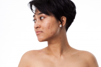 Leaving a Mark: A Guide to Understanding &amp;amp; Treating Acne Scarring