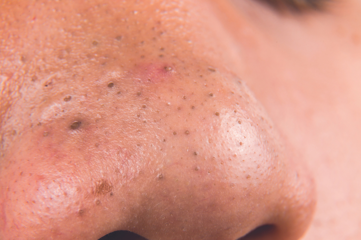 Pore Things: The Miseducation of Blackheads &amp; Pore Appearance 