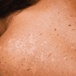 Blistering Sunburn