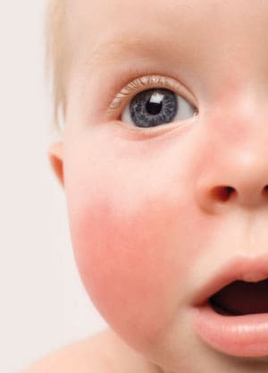 Port Wine Stain Birthmarks – January 2011