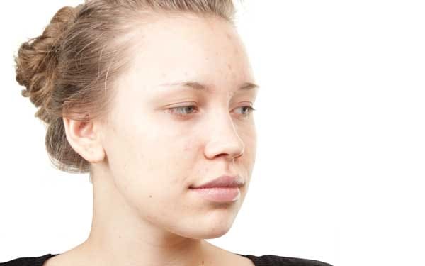 Inflammation – An Immune Response