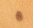 Should I Worry About All Moles on My Child’s Skin?