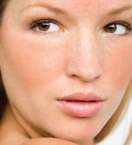 Getting Ready for Rosacea Awareness Month