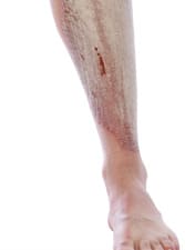 Psoriasis-Vulgaris-on-shin