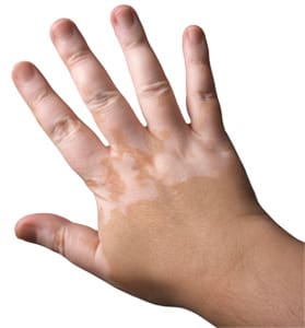 Vitiligo
