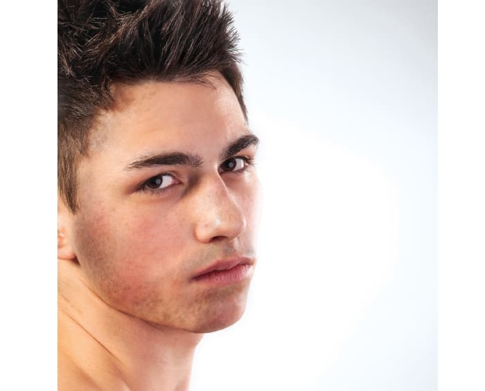Hyperpigmentation