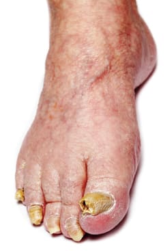Slightly Sunken/Spoon Shaped Toenails