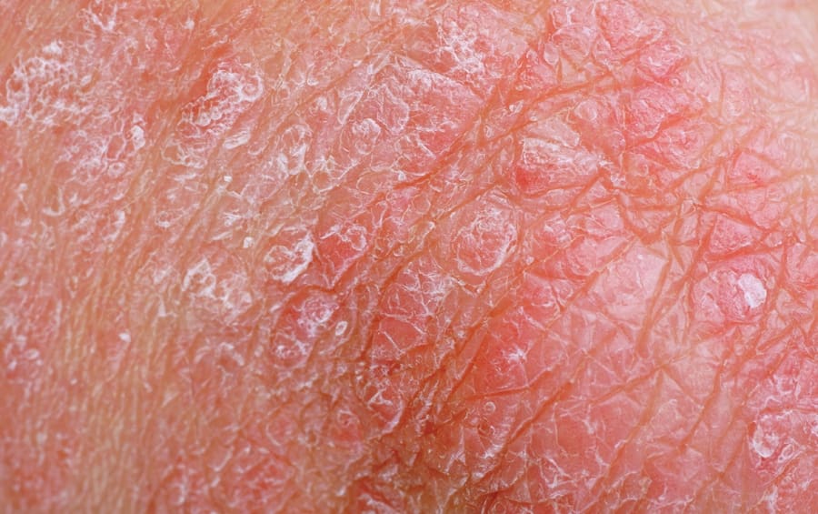 New Rosacea Survey Pinpoints Flushing and Redness as First Signs