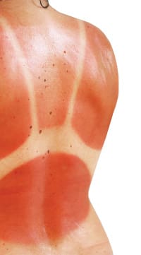 sun-burn-back