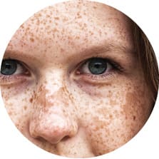 melasma