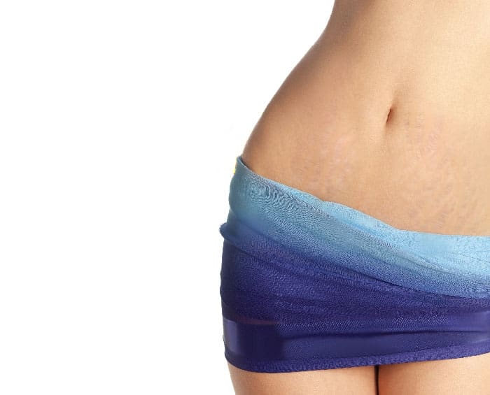Stretch Marks