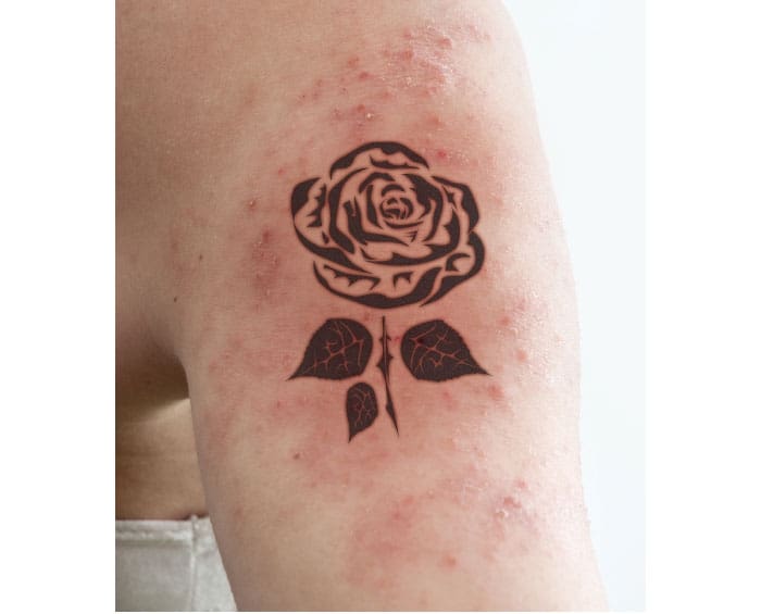 Infected Tattoos in the Treatment Room