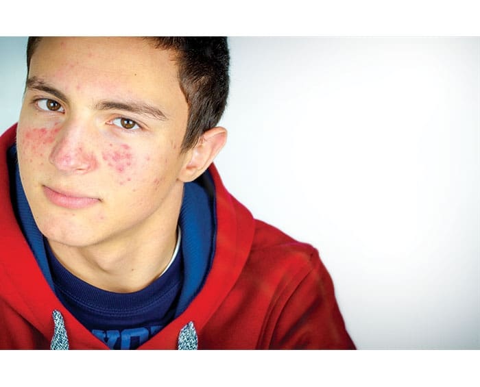 Myths and Realities of Acne