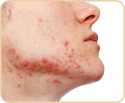 hormonal-acne