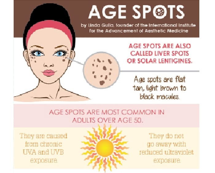 Age Spots