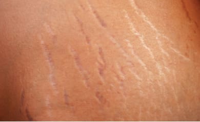 Stretch-Marks