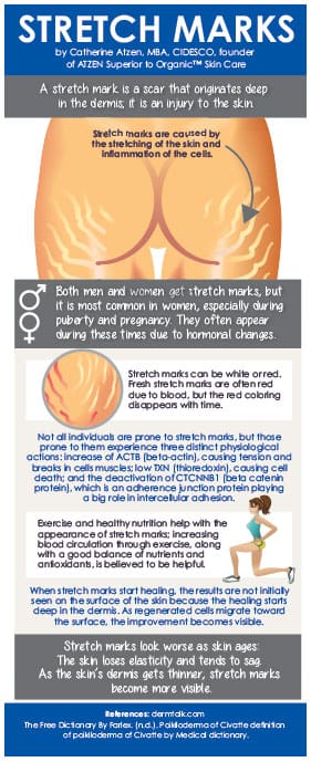 Infographic: Stretch Marks