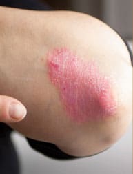 psoriasis