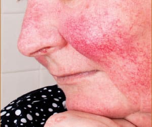 rosacea