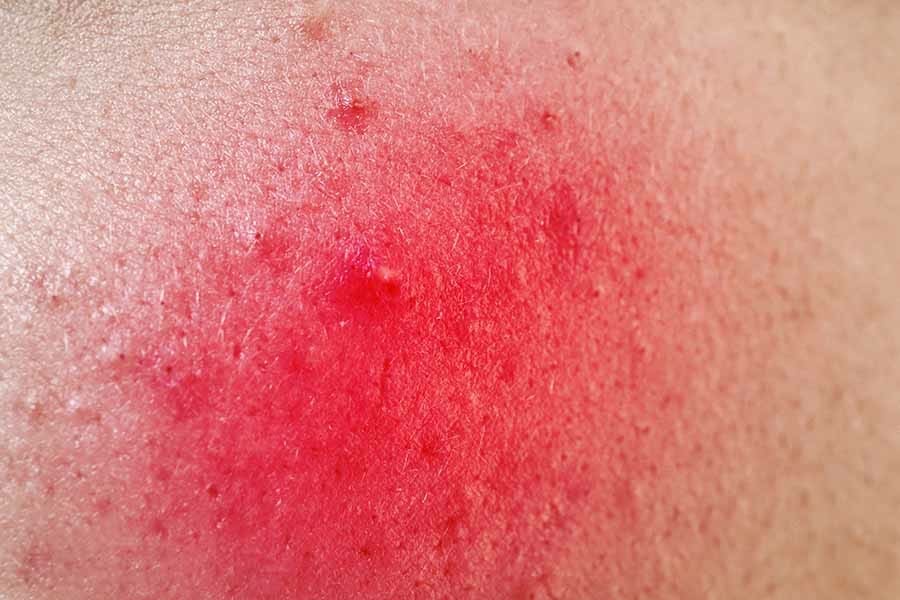 Acne or Rosacea: How Quality Images Help with the Difficult Task of Determining Which is Which