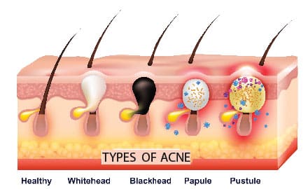 types of acne